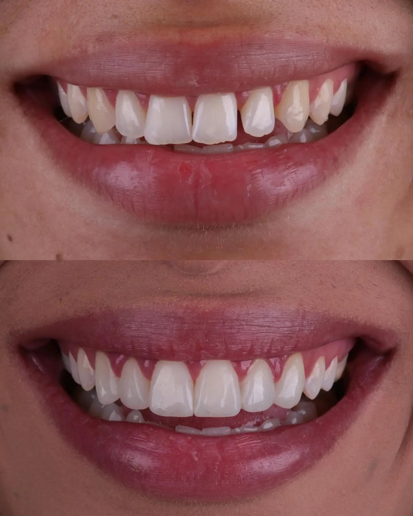 Clareamento + Facetas em Resina Composta