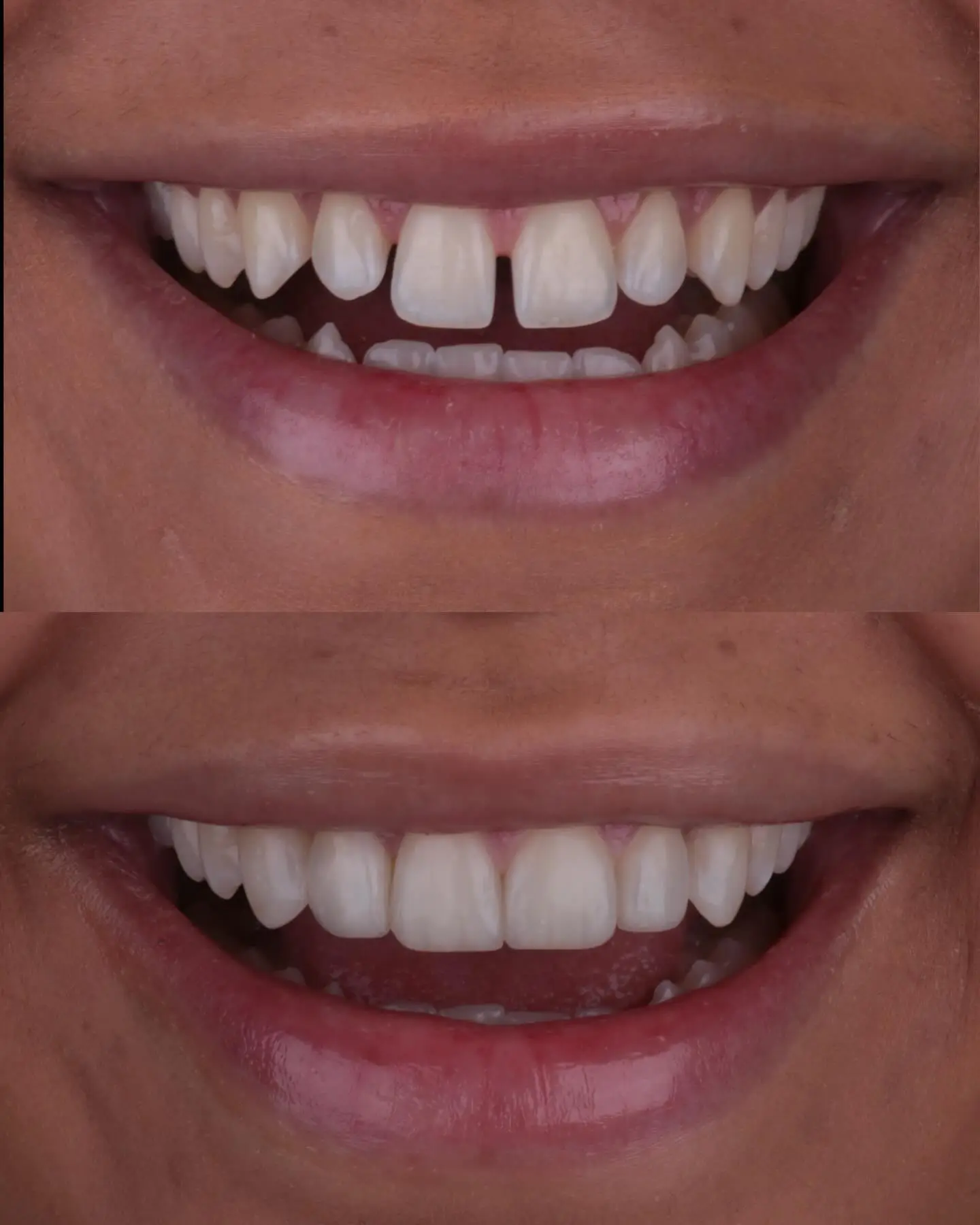 Gengivoplastia + Clareamento